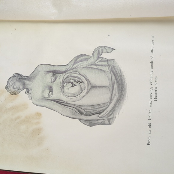 Antique 1915 Obstetrics For Nurses Book - Picture 8 of 13